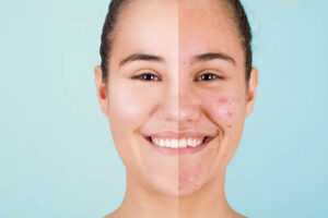 Problematic skin before and after treatment.